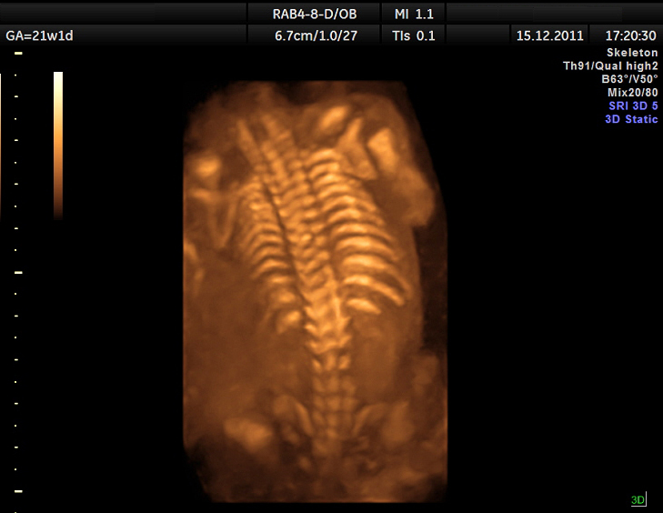 ultrasound_of_fetal_spine_at_20_weeks_3d_dr-_moroder